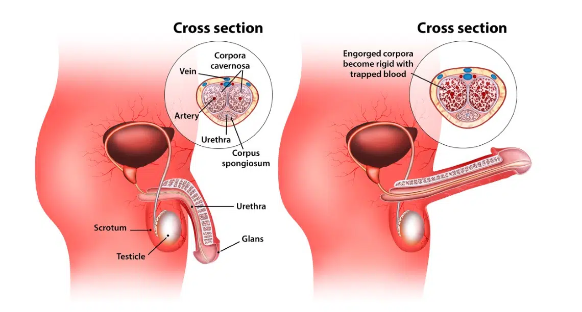 Erectile dysfunction illustration